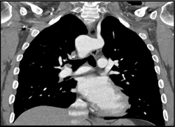 Aberrant Left Subclavian Off Right Sided Arch - CTisus CT Scan