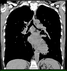 Virtual Bronchoscopy With Encased Left Mainstem Bronchus - CTisus CT Scan