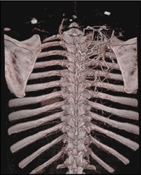 Collaterals in Paraspinal Zone - CTisus CT Scan