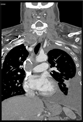 Malignant Clot in SVC With SVC Syndrome (lung Cancer) - CTisus CT Scan