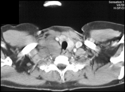 Right Supraclavicular Nodes - CTisus CT Scan