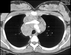 Lymphoma - CTisus CT Scan