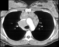 Lymphoma - CTisus CT Scan