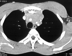 Lymphoma - CTisus CT Scan