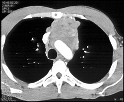 Lymphoma - CTisus CT Scan