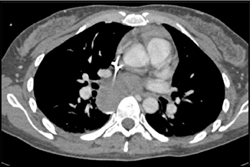 Lymphoma - CTisus CT Scan