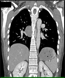 Lymphoma - CTisus CT Scan