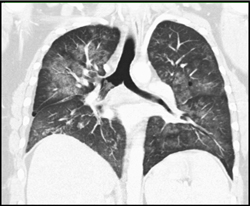 Plastic Bronchitis - CTisus CT Scan