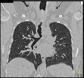 Tumor Encasement of Trachea - CTisus CT Scan