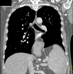 Hiatal Hernia - CTisus CT Scan