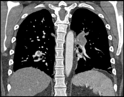 Pulmonary Embolism - CTisus CT Scan