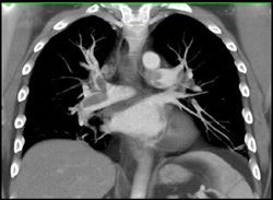 Pulmonary Embolism - CTisus CT Scan