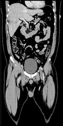 Pulmonary Embolism - CTisus CT Scan