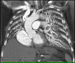 Normal Aortic Arch - CTisus CT Scan