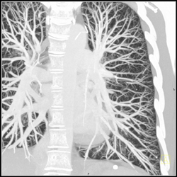 64 Slice MDCT of Pulmonary Vasculature - CTisus CT Scan