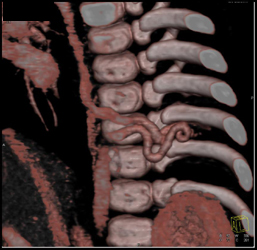 Fistulae in A Av Child - CTisus CT Scan