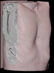 Pectus Deformity - CTisus CT Scan