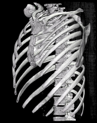 Pectus Deformity - CTisus CT Scan