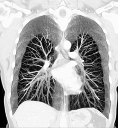 Normal Lung Parenchyma and Vasculature in 64 MDCT - CTisus CT Scan