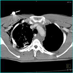 Pneumomediastinum Post Tracheostomy - CTisus CT Scan