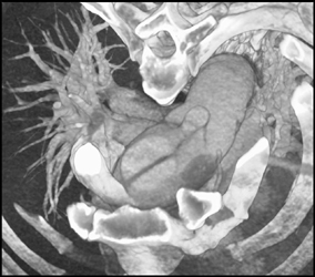 Aortic Dissection - CTisus CT Scan