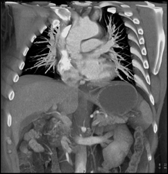 Type A Dissection - CTisus CT Scan