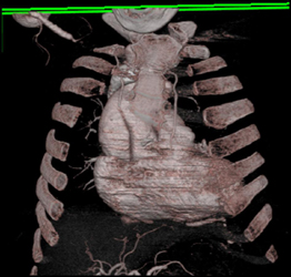 Type A Dissection - CTisus CT Scan