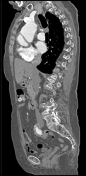 Type A Dissection - CTisus CT Scan