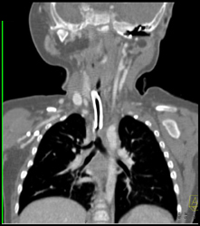 Pig Bronchus - CTisus CT Scan