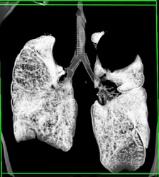 Virtual Bronchoscopy With Stents - CTisus CT Scan