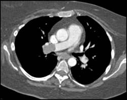 Pulmonary Embolism - CTisus CT Scan