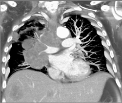 NSCLC Encases Pulmonary Artery - CTisus CT Scan