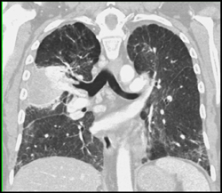 Idiopathic Pulmonary Hemosiderosis - CTisus CT Scan