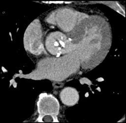 Calcified Aortic Valve - CTisus CT Scan