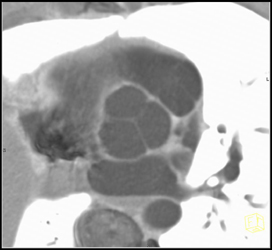 Normal Aortic Valve - CTisus CT Scan