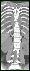 Tuberculosis (TB) Osteomyelitis - CTisus CT Scan