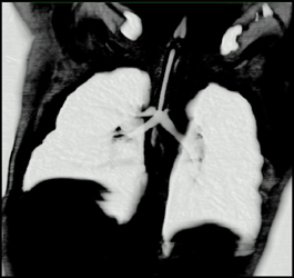 Tracheal Stenosis With Stent - CTisus CT Scan