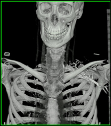 Normal Jugular Veins - CTisus CT Scan