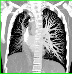 Hypoperfusion in Right Lung - CTisus CT Scan