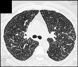 Fungal Infection - CTisus CT Scan