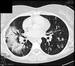 Pulmonary Hemorrhage - CTisus CT Scan