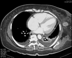 Pericardial Effusion With Breast Cancer - CTisus CT Scan