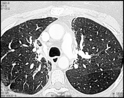 S/P Radiation Therapy - CTisus CT Scan