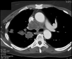 Lung Cancer Invades SVC - CTisus CT Scan