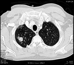 Pulmonary Hemorrhage - CTisus CT Scan