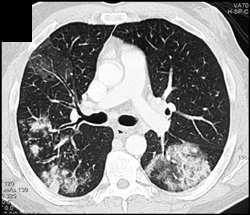 Pulmonary Hemorrhage - CTisus CT Scan