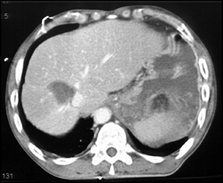 Tear of Left Hemidiaphragm - CTisus CT Scan