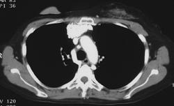 Calcified Nodes - CTisus CT Scan