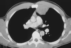 Chondrosarcoma - CTisus CT Scan