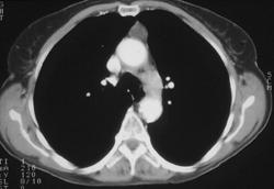 Thymoma - CTisus CT Scan